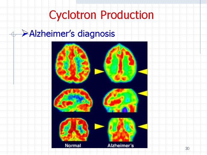 Cyclotron Production ØAlzheimer’s diagnosis 30 