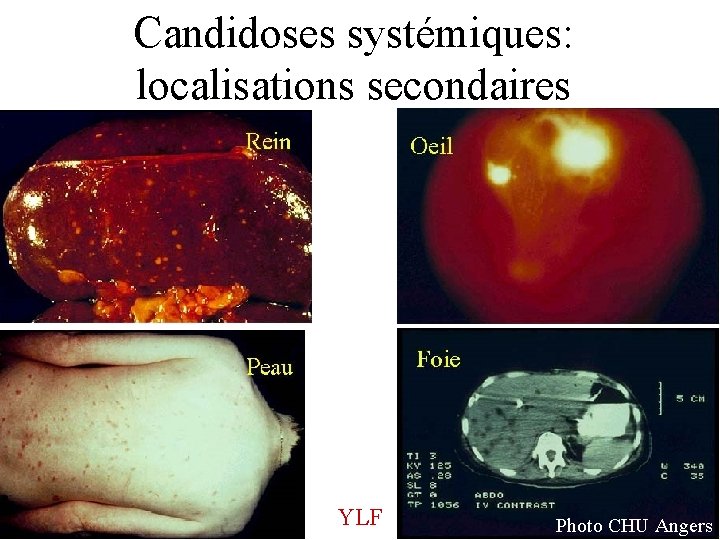 Candidoses systémiques: localisations secondaires YLF Photo CHU Angers 