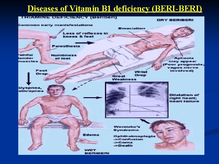 Diseases of Vitamin B 1 deficiency (BERI-BERI) 