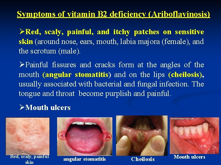 Symptoms of vitamin B 2 deficiency (Ariboflavinosis) ØRed, scaly, painful, and itchy patches on