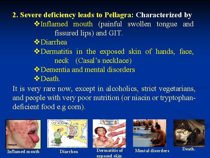 2. Severe deficiency leads to Pellagra: Characterized by v. Inflamed mouth (painful swollen tongue