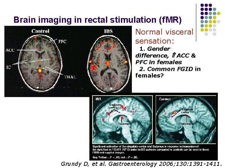 Brain imaging in rectal stimulation (f. MR) Normal visceral sensation: 1. Gender difference, ACC