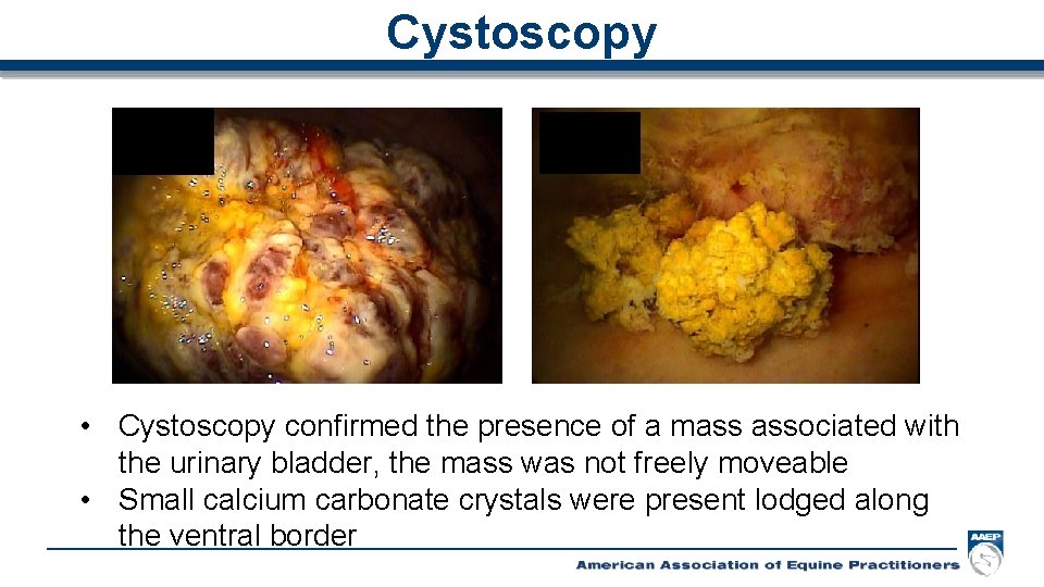 Cystoscopy • Cystoscopy confirmed the presence of a mass associated with the urinary bladder,