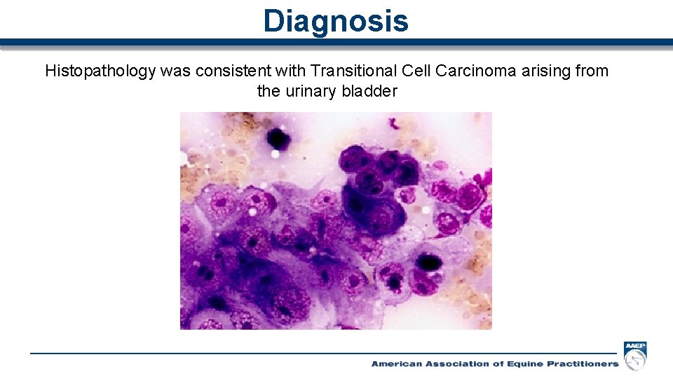 Diagnosis Histopathology was consistent with Transitional Cell Carcinoma arising from the urinary bladder 