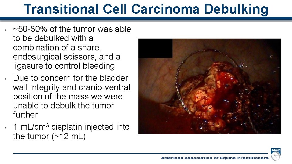 Transitional Cell Carcinoma Debulking • • • ~50 -60% of the tumor was able