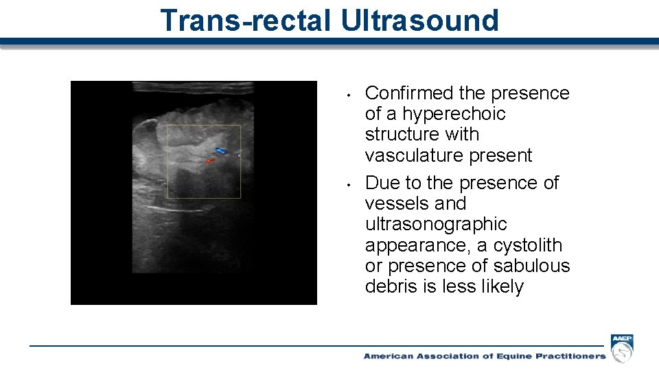 Trans-rectal Ultrasound • • Confirmed the presence of a hyperechoic structure with vasculature present