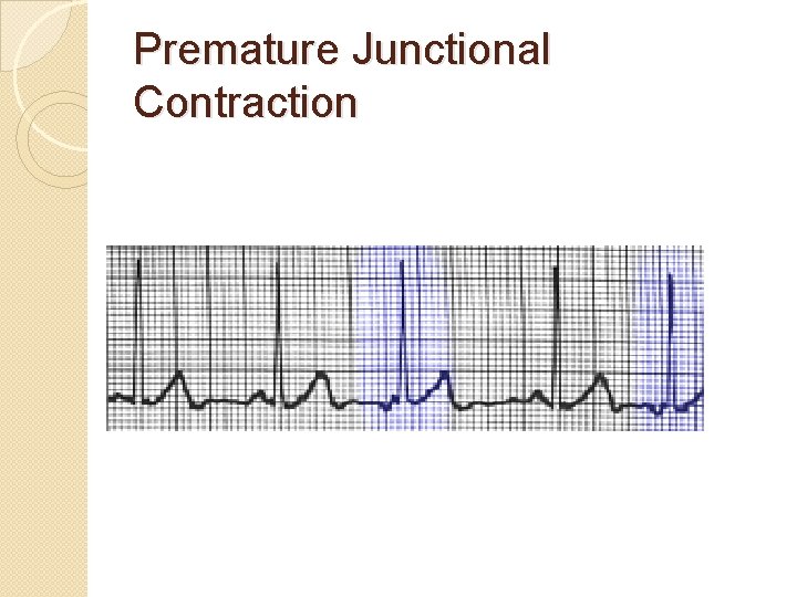 Premature Junctional Contraction 