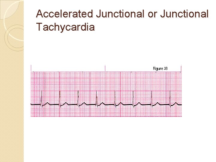 Accelerated Junctional or Junctional Tachycardia 