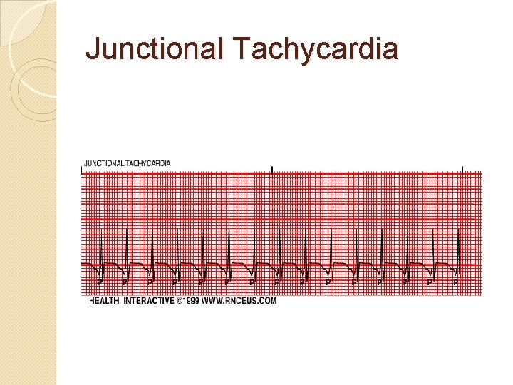 Junctional Tachycardia 