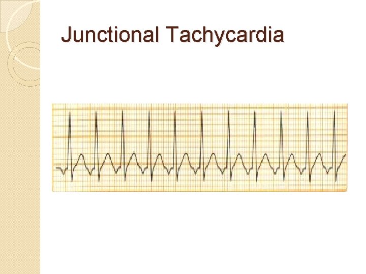 Junctional Tachycardia 