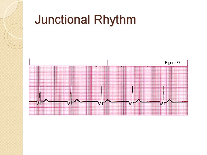 Junctional Rhythm 