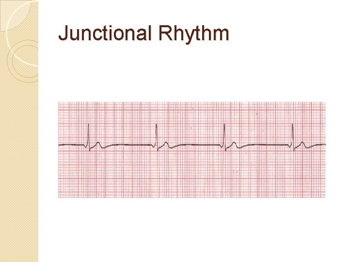 Junctional Rhythm 