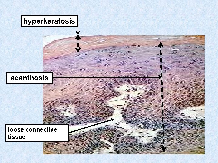 hyperkeratosis . acanthosis loose connective tissue 
