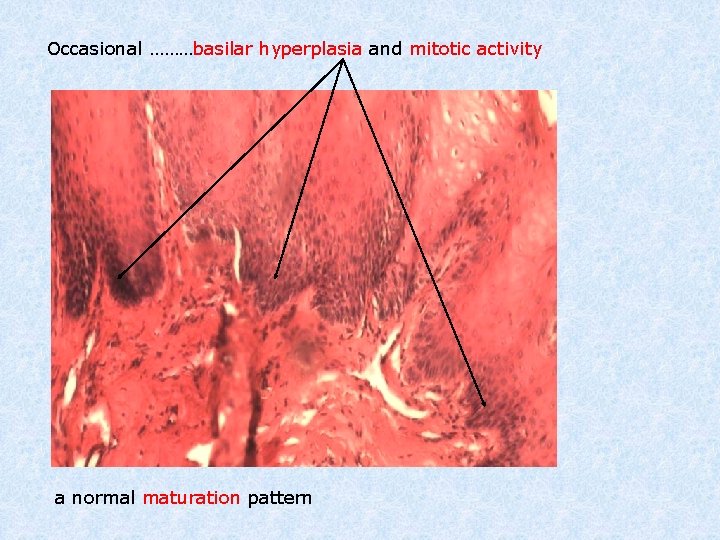 Occasional ………basilar hyperplasia and mitotic activity a normal maturation pattern 