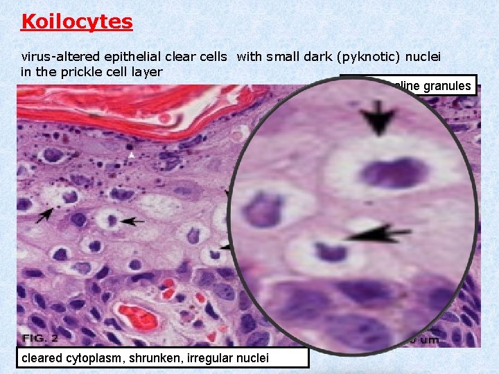 Koilocytes virus-altered epithelial clear cells with small dark (pyknotic) nuclei in the prickle cell