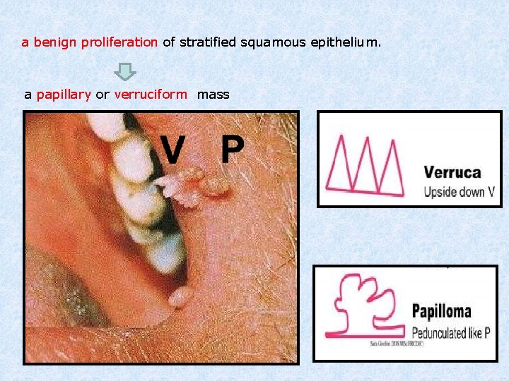 a benign proliferation of stratified squamous epithelium. a papillary or verruciform mass 