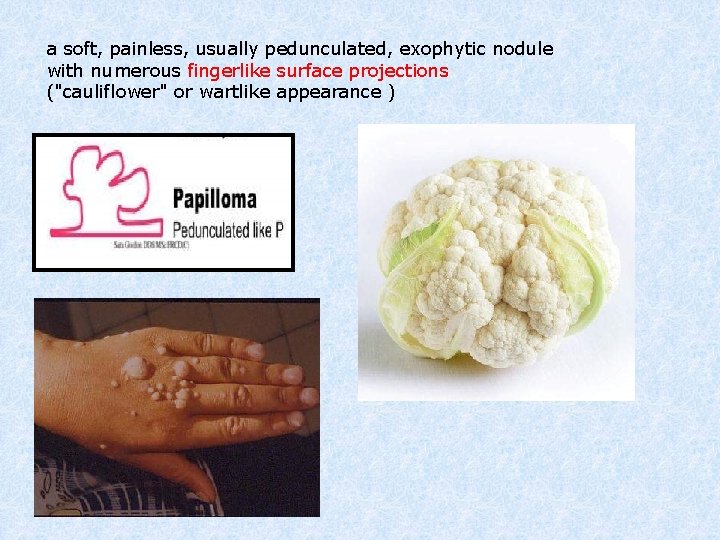 a soft, painless, usually pedunculated, exophytic nodule with numerous fingerlike surface projections ("cauliflower" or