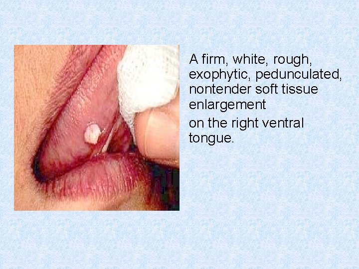 A firm, white, rough, exophytic, pedunculated, nontender soft tissue enlargement on the right ventral