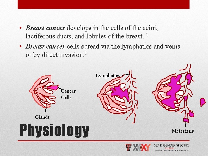  • Breast cancer develops in the cells of the acini, lactiferous ducts, and