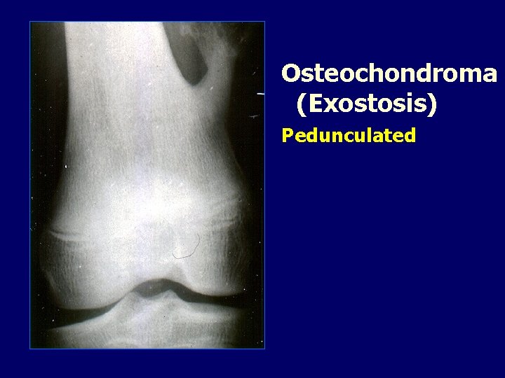 Osteochondroma (Exostosis) Pedunculated 