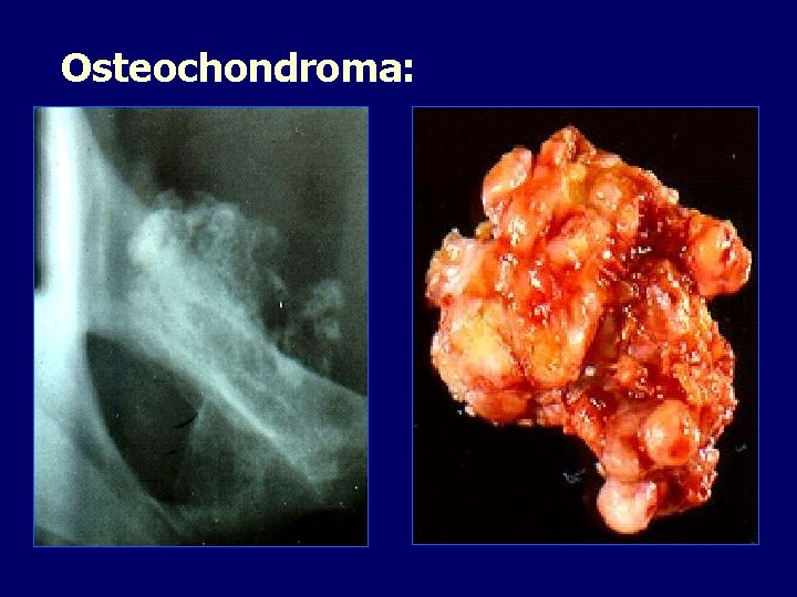 Osteochondroma: 