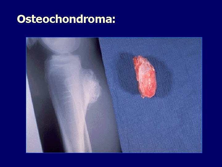 Osteochondroma: 