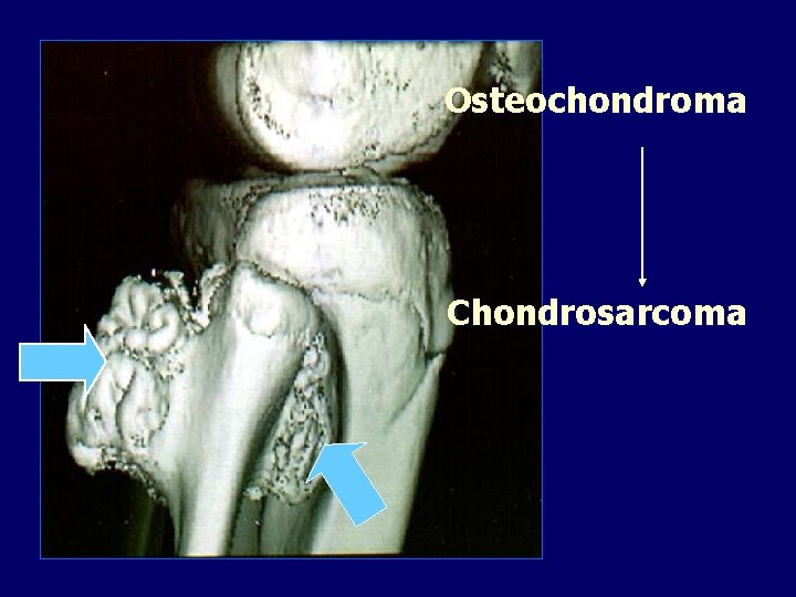 Osteochondroma Chondrosarcoma 