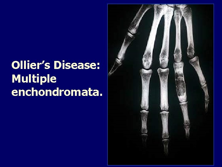 Ollier’s Disease: Multiple enchondromata. 