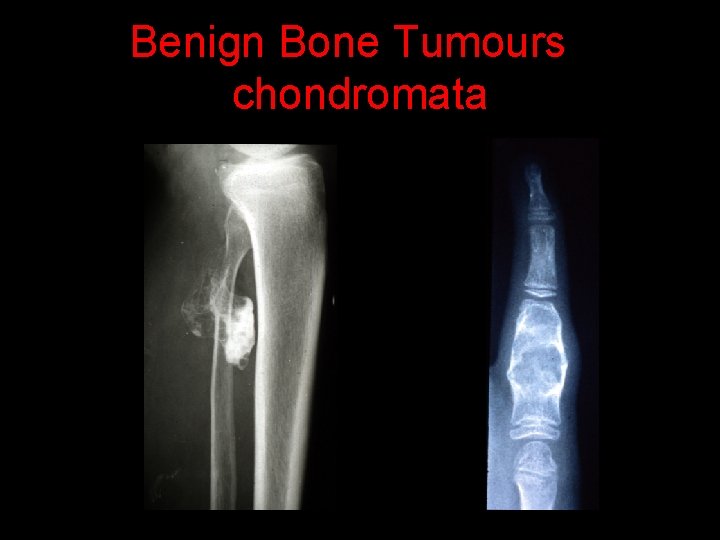 Benign Bone Tumours chondromata 