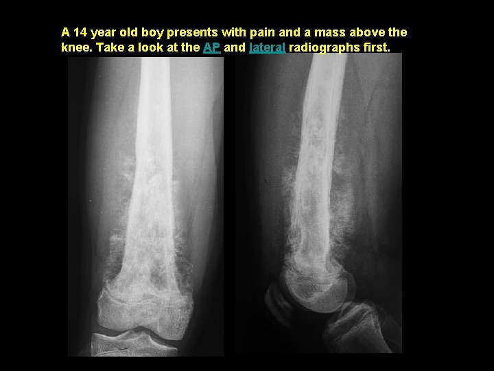 A 14 year old boy presents with pain and a mass above the knee.