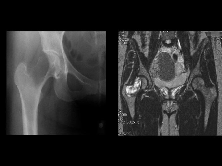 Example 4*, 35 y/o F, GCT 