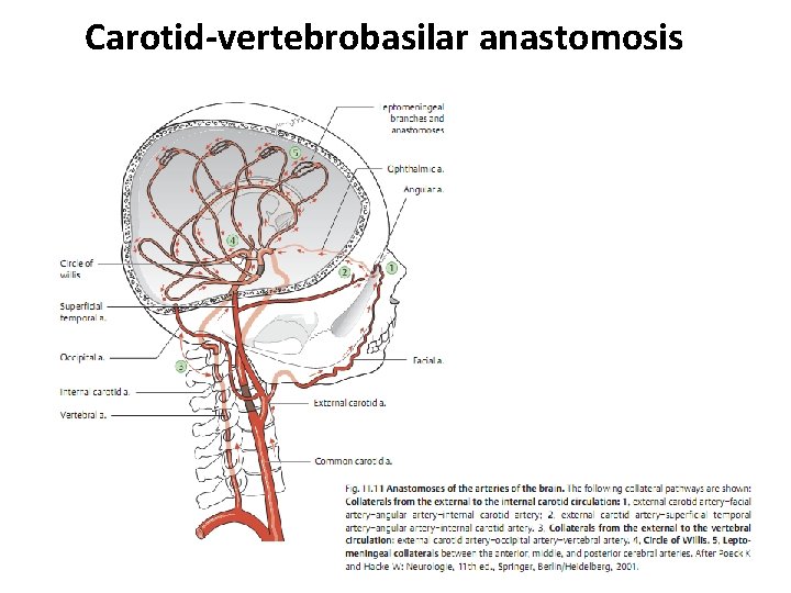 Carotid-vertebrobasilar anastomosis 