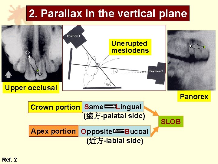 2. Parallax in the vertical plane Unerupted mesiodens Upper occlusal Panorex Lingual Crown portion 2. Parallax in the vertical plane Unerupted mesiodens Upper occlusal Panorex Lingual Crown portion