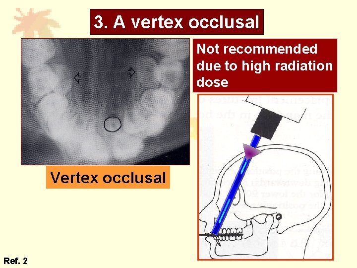 3. A vertex occlusal Not recommended due to high radiation dose Vertex occlusal Ref.