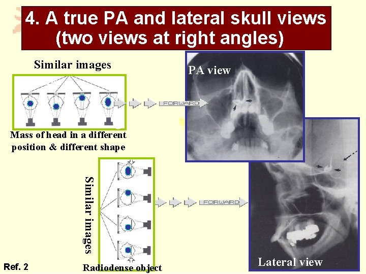 4. A true PA and lateral skull views (two views at right angles) Similar
