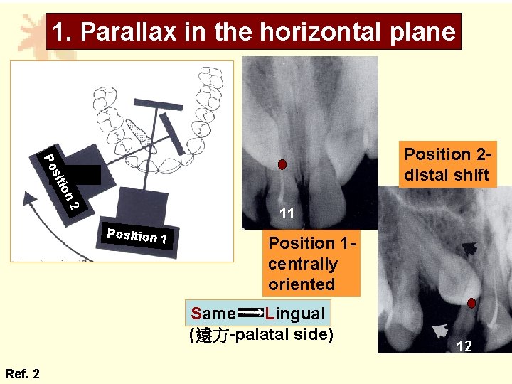 1. Parallax in the horizontal plane ion sit Po Position 2 distal shift 2