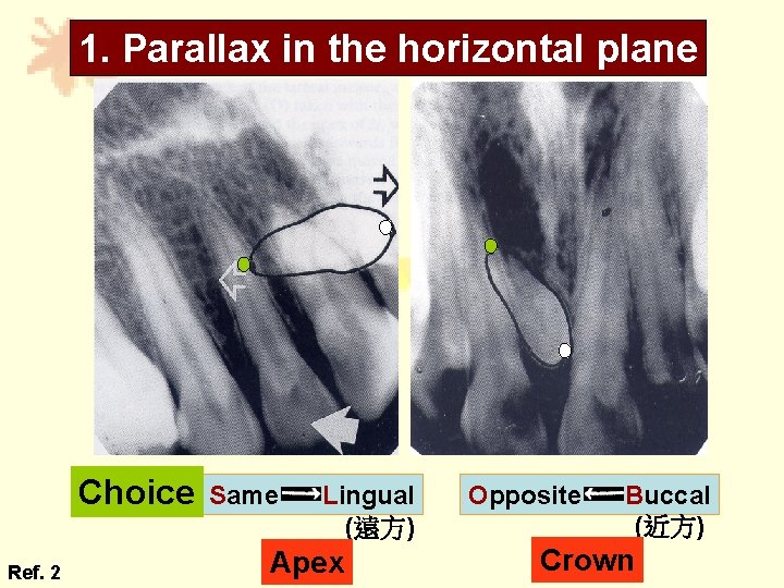1. Parallax in the horizontal plane Choice Ref. 2 Same Lingual (遠方) Apex Opposite 1. Parallax in the horizontal plane Choice Ref. 2 Same Lingual (遠方) Apex Opposite