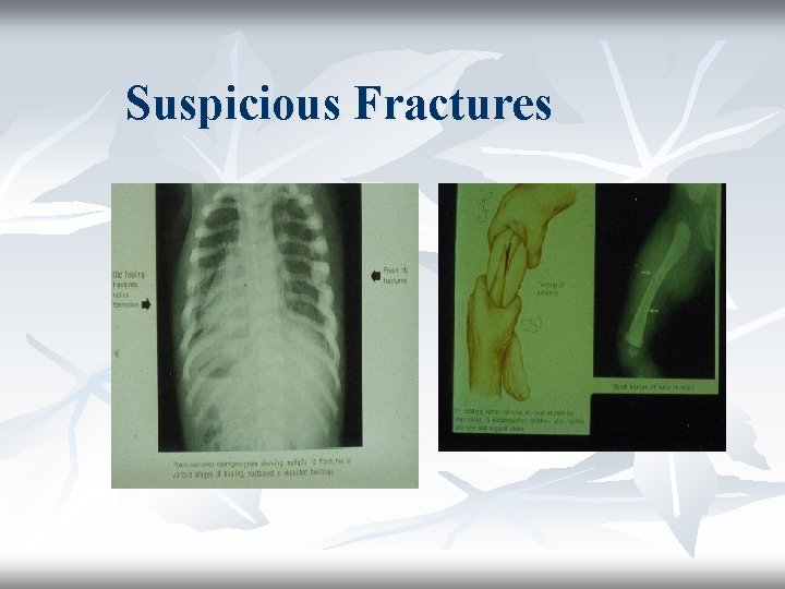 Suspicious Fractures 