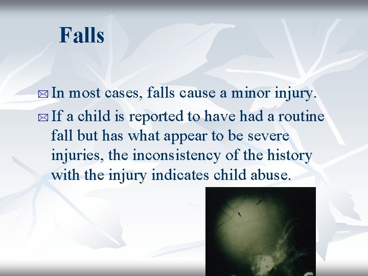 Falls In most cases, falls cause a minor injury. * If a child is