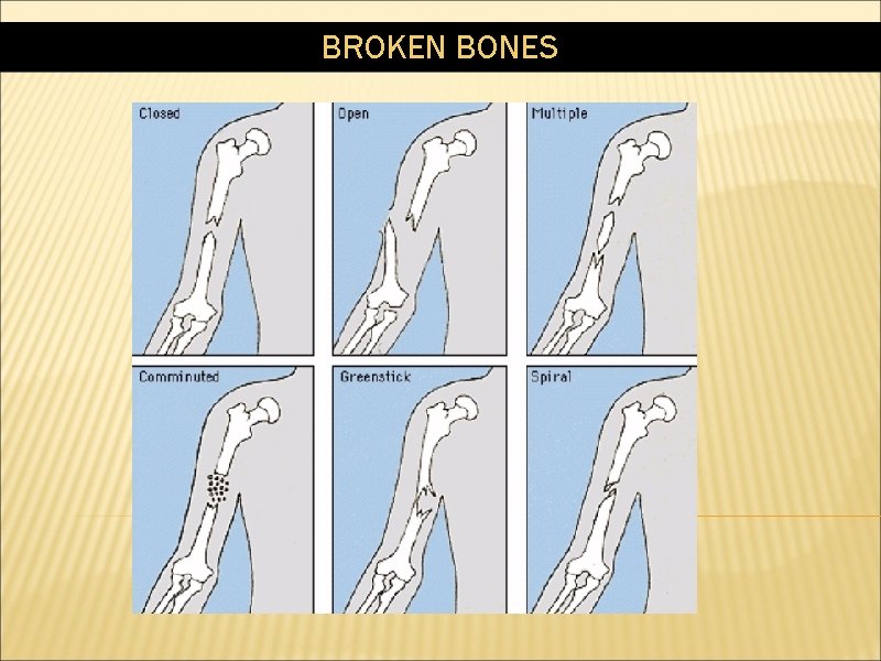 BROKEN BONES 