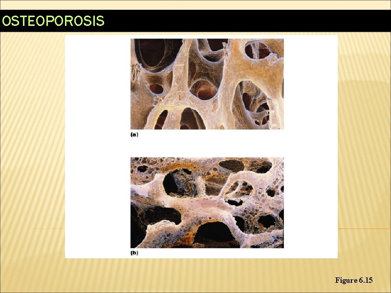 OSTEOPOROSIS Figure 6. 15 