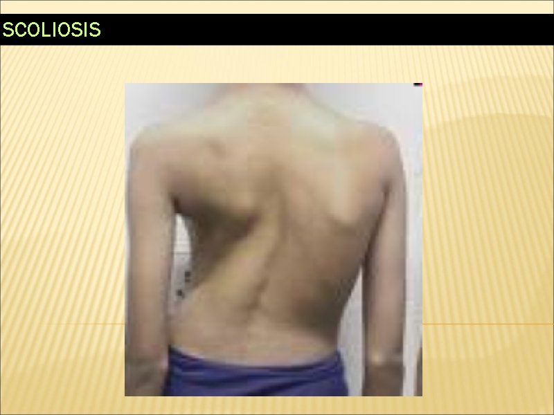 SCOLIOSIS 