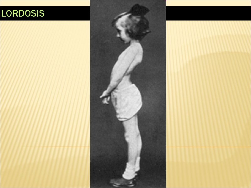 LORDOSIS 