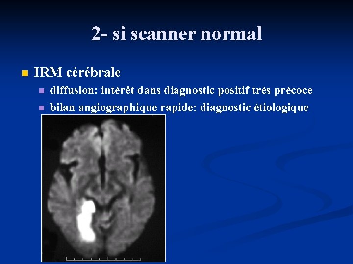 2 - si scanner normal n IRM cérébrale n n diffusion: intérêt dans diagnostic