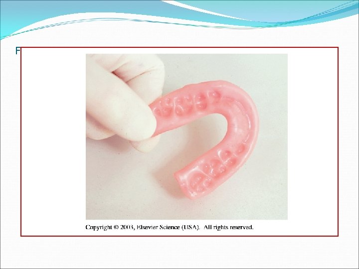 Fig. 46 -27 Wax bite registration. 
