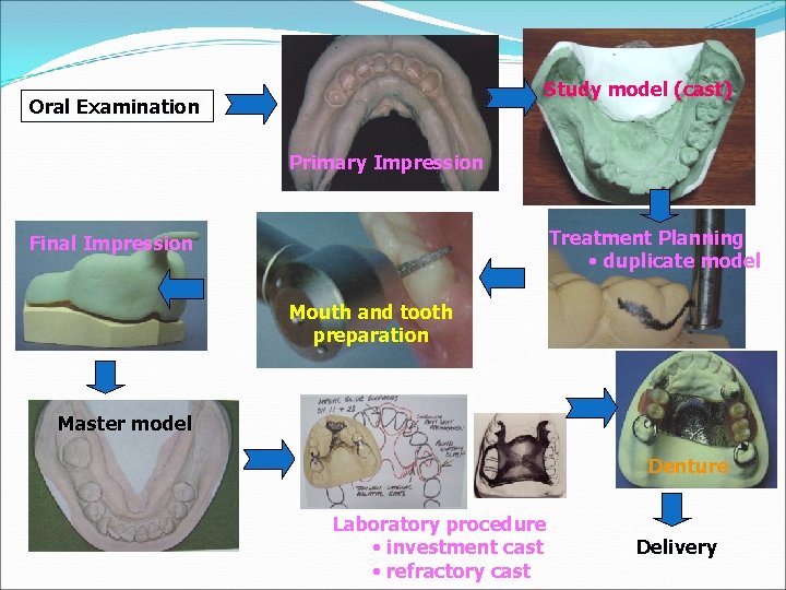 Study model (cast) Oral Examination Primary Impression Treatment Planning • duplicate model Final Impression