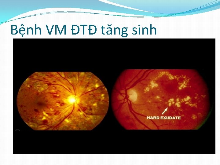 Bệnh VM ĐTĐ tăng sinh 