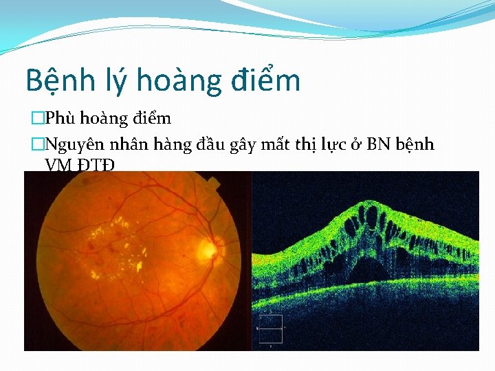 Bệnh lý hoàng điểm �Phù hoàng điểm �Nguyên nhân hàng đầu gây mất thị