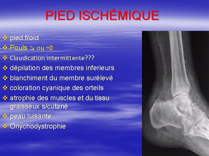 PIED ISCHÉMIQUE v pied froid v Pouls ↘ ou =0 v Claudication intermittente? ?