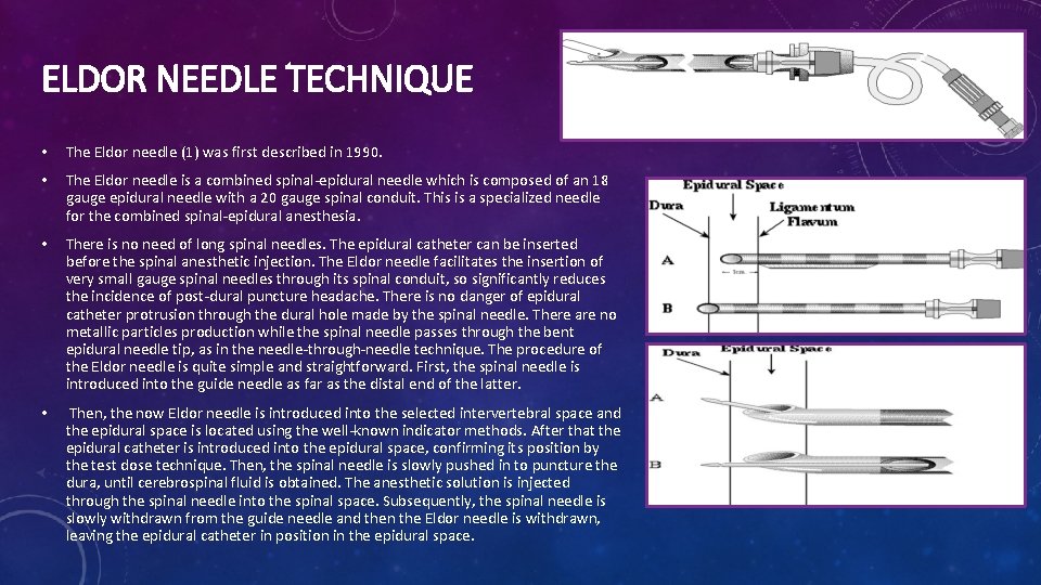 ELDOR NEEDLE TECHNIQUE • The Eldor needle (1) was first described in 1990. • ELDOR NEEDLE TECHNIQUE • The Eldor needle (1) was first described in 1990. •